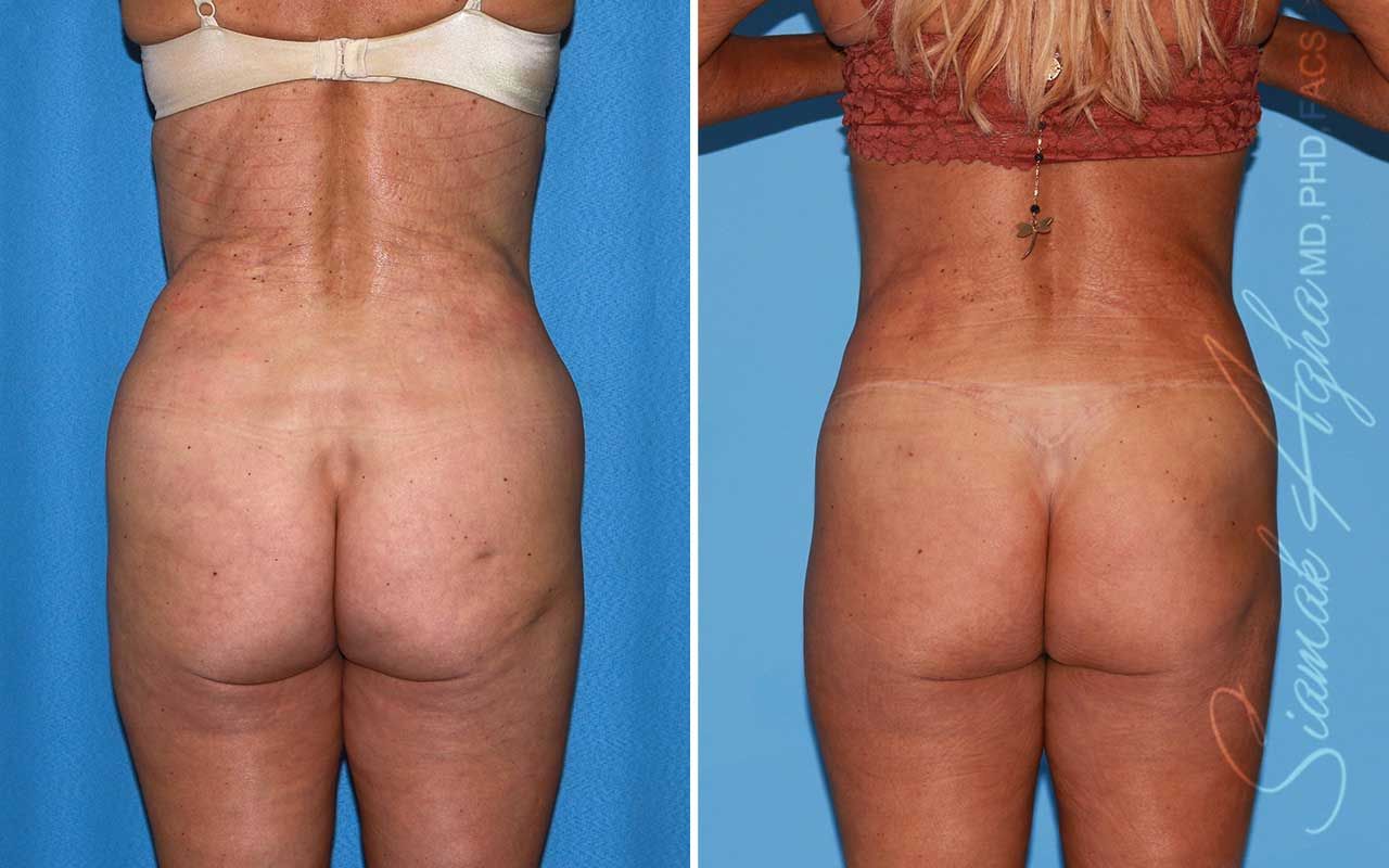 Lower Body Lift Before & After
