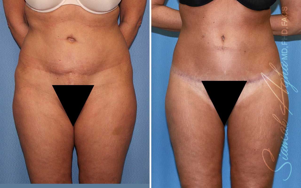 Lower Body Lift Before & After