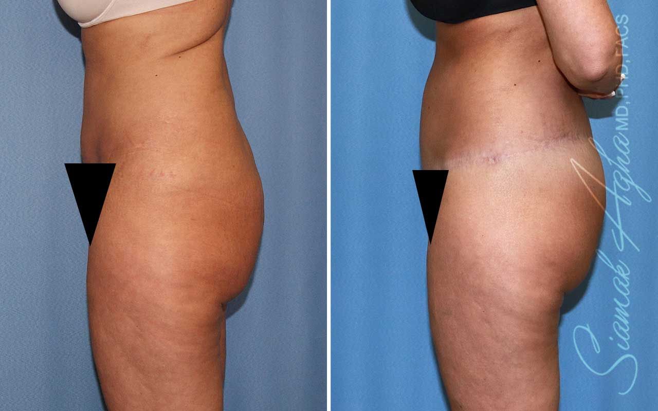 Lower Body Lift Before & After