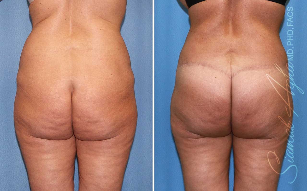 Lower Body Lift Before & After