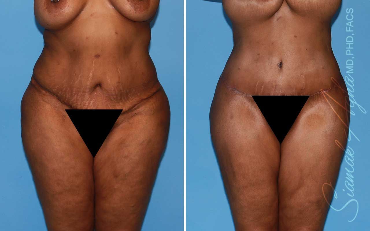Lower Body Lift Before & After