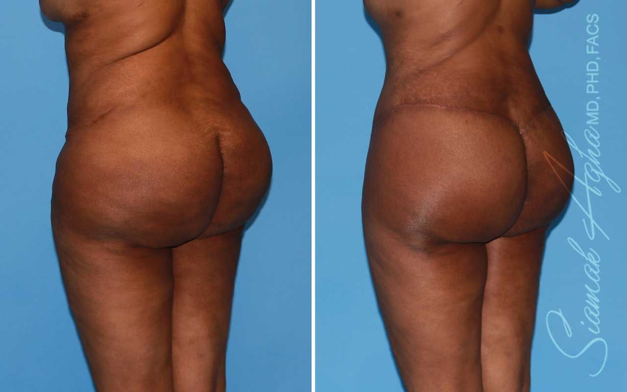 Lower Body Lift Before & After