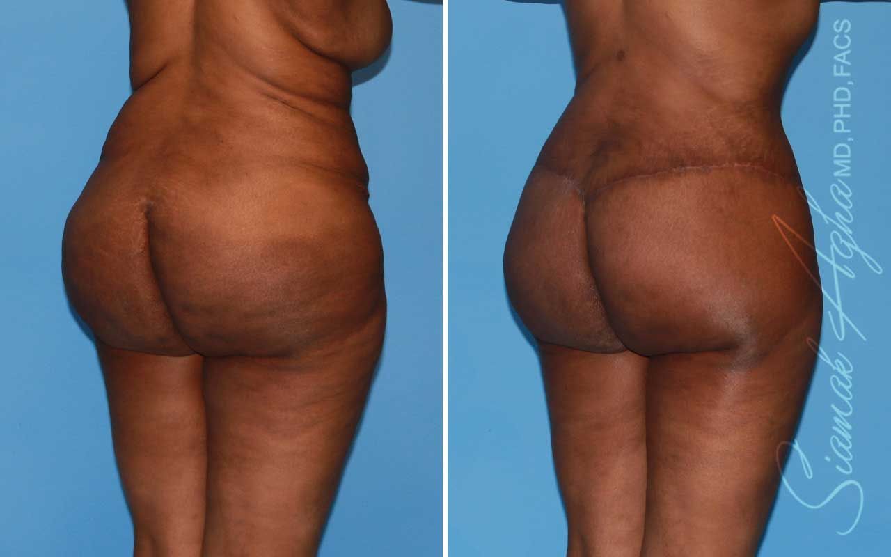 Lower Body Lift Before & After