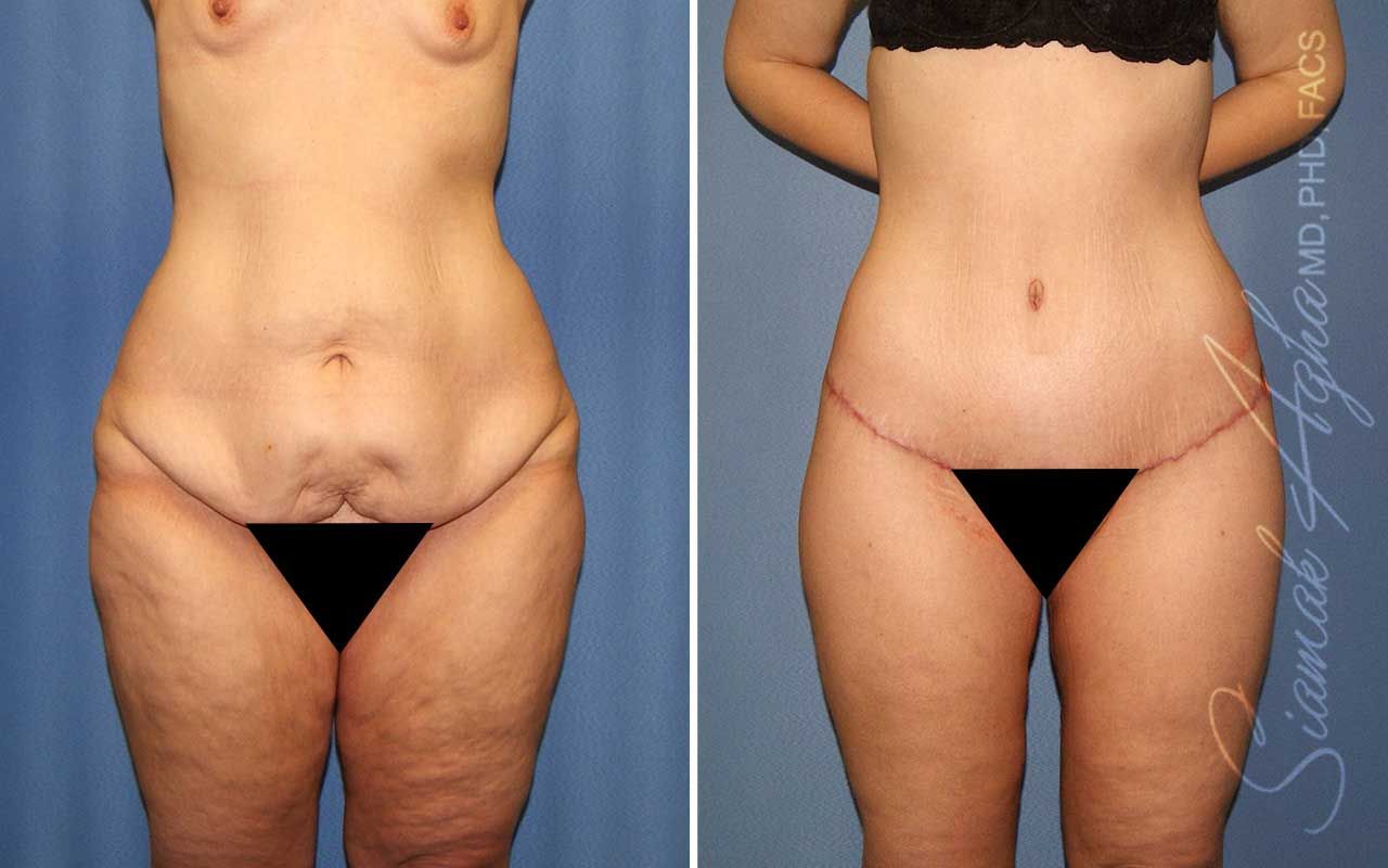 Lower Body Lift Before & After