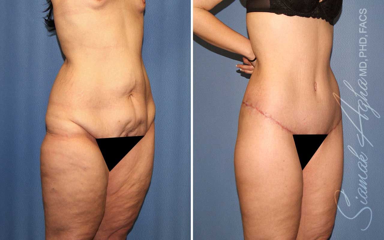 Lower Body Lift Before & After