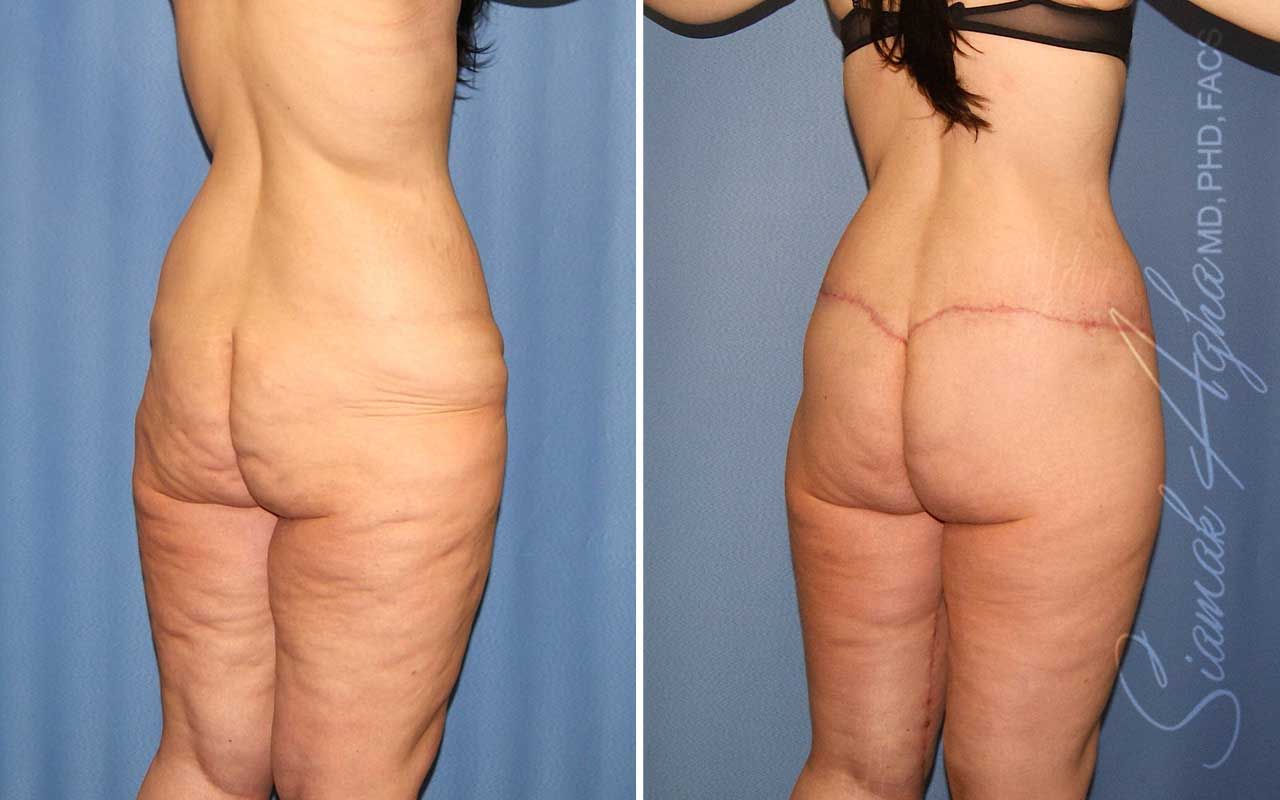Lower Body Lift Before & After