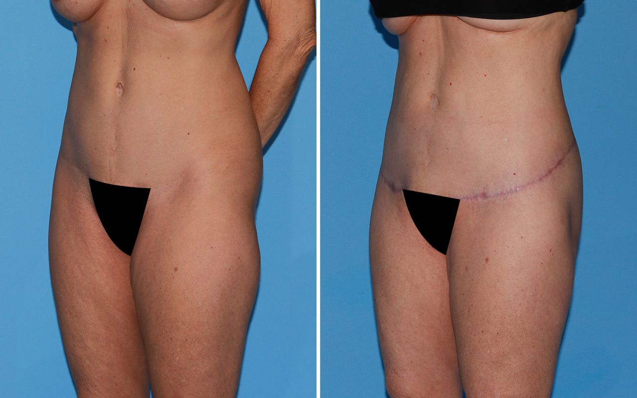 Lower Body Lift Before & After