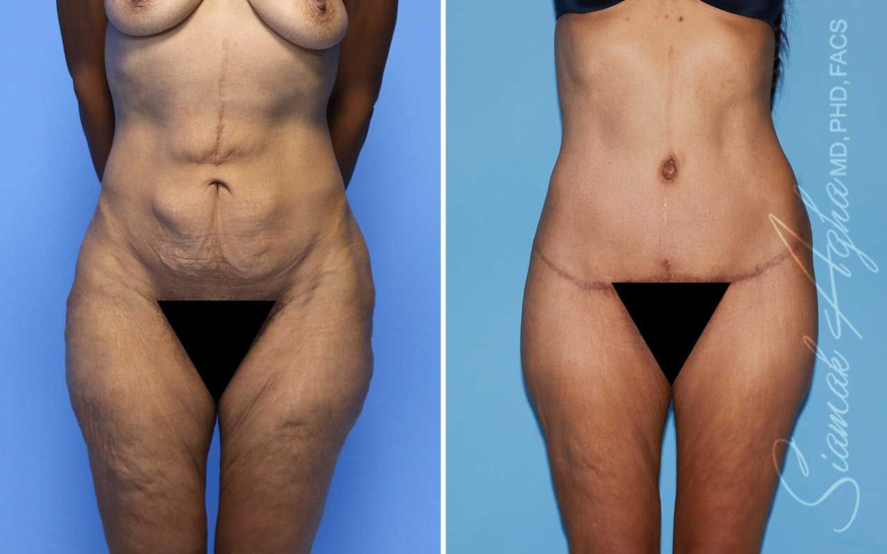 Lower Body Lift Before & After