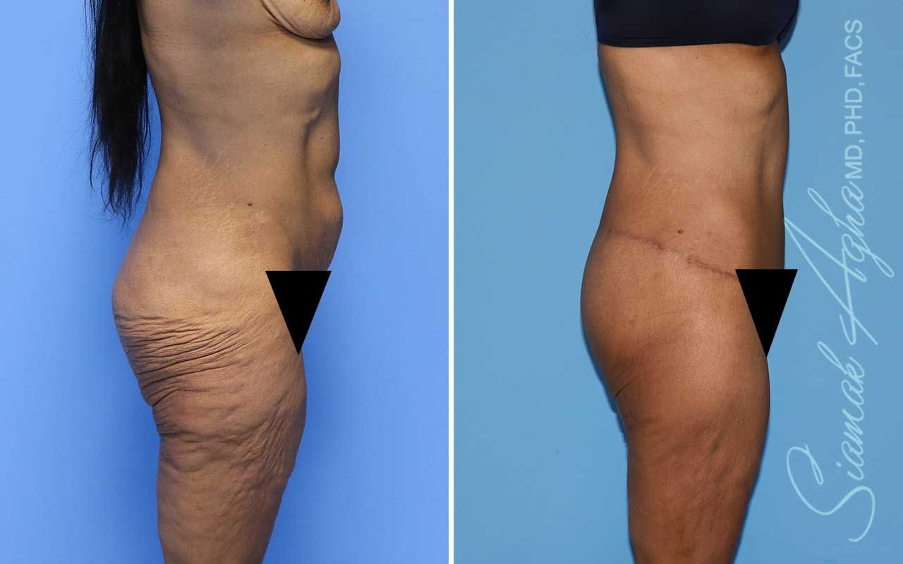 Lower Body Lift Before & After