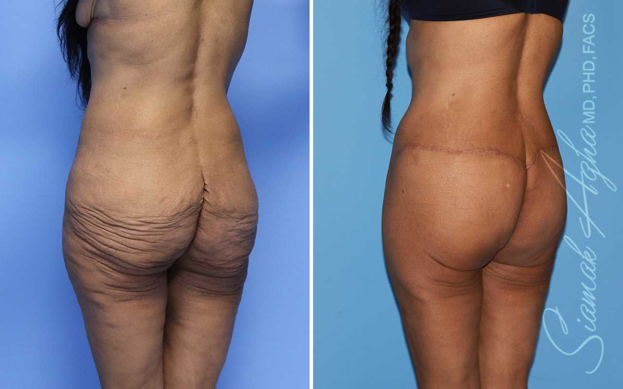 Lower Body Lift Before & After