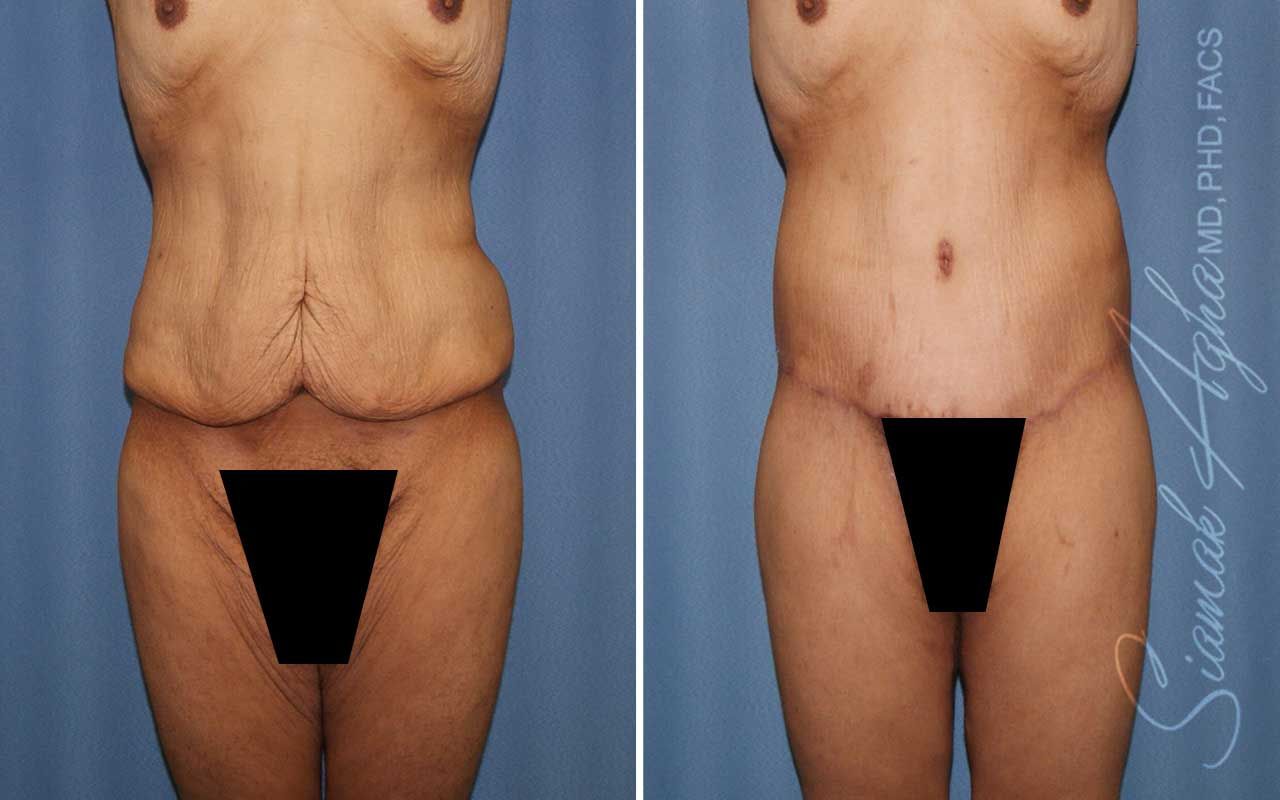 Lower Body Lift Before & After