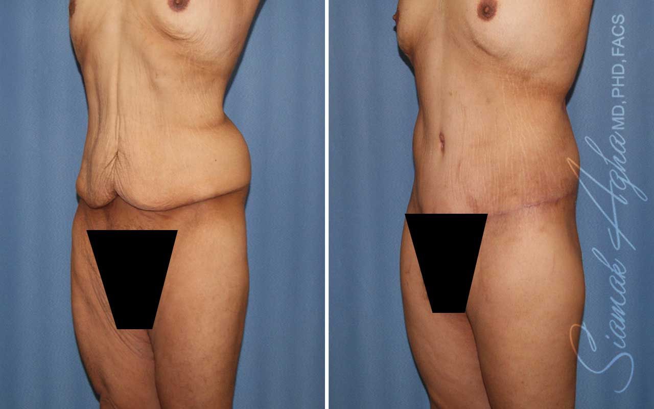 Lower Body Lift Before & After