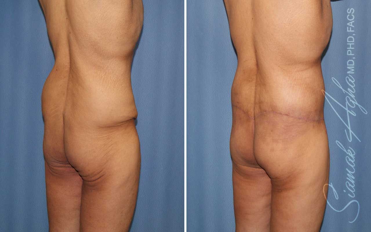 Lower Body Lift Before & After