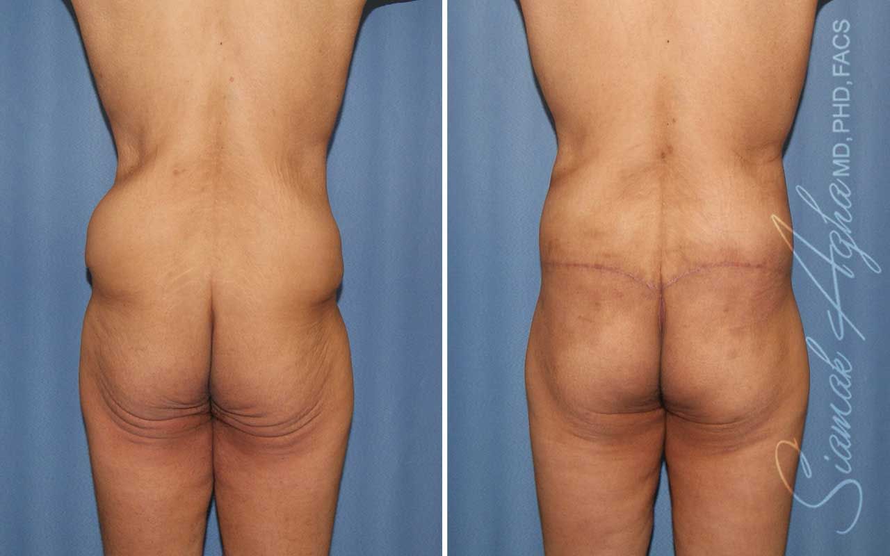 Lower Body Lift Before & After