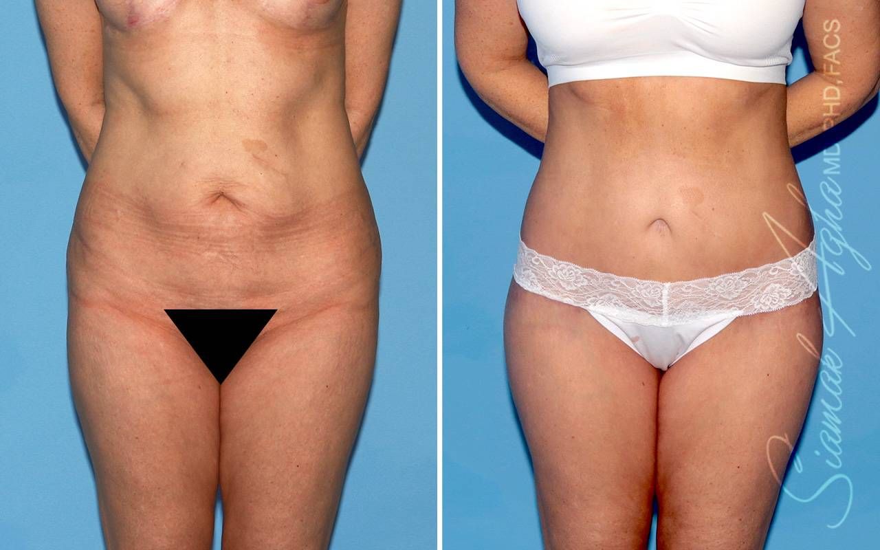 Lower Body Lift Before & After