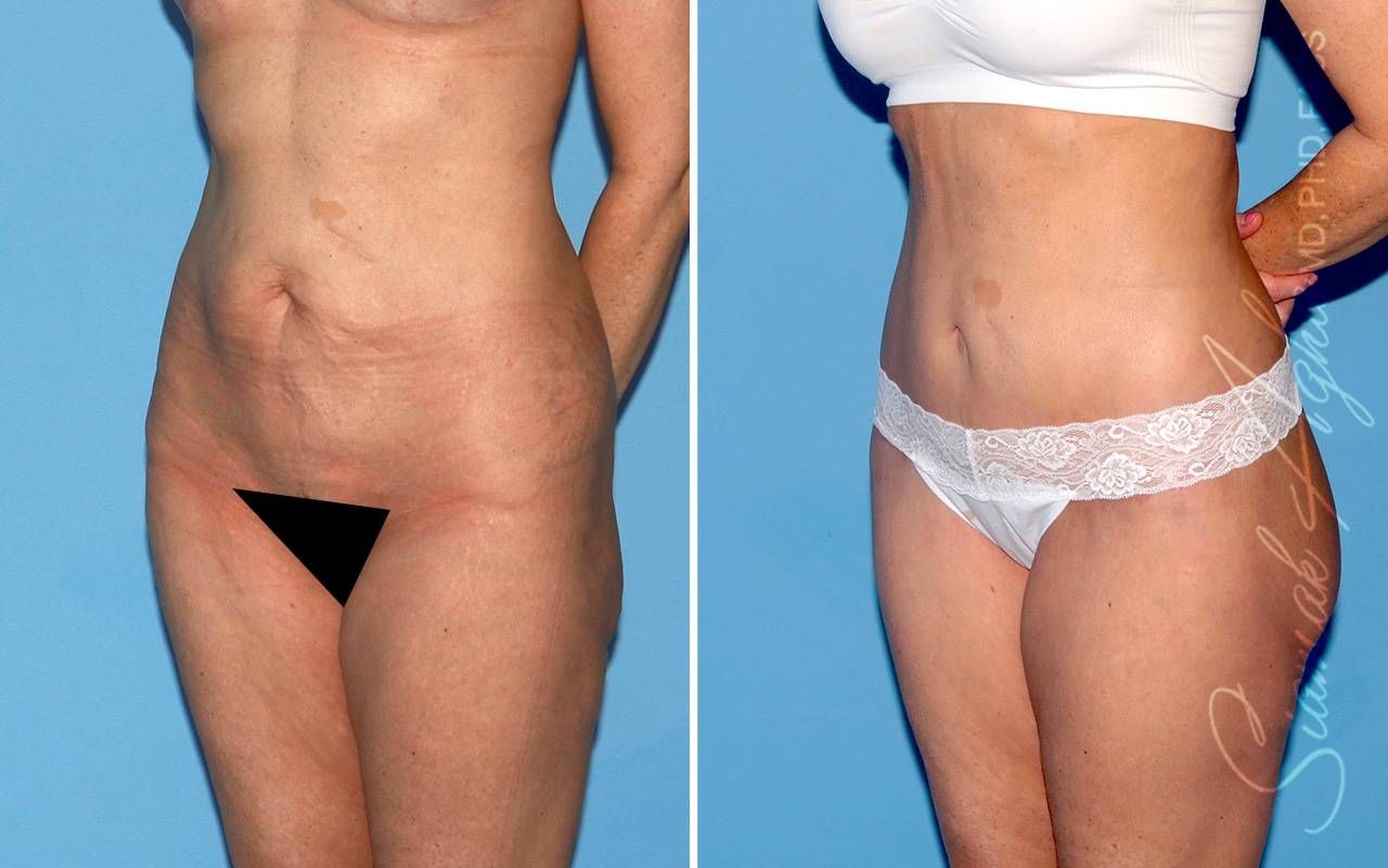 Lower Body Lift Before & After