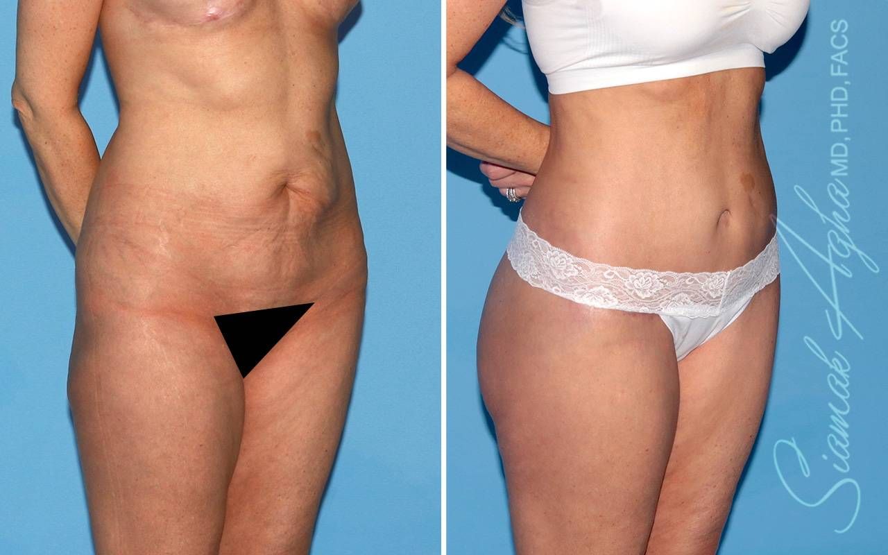 Lower Body Lift Before & After