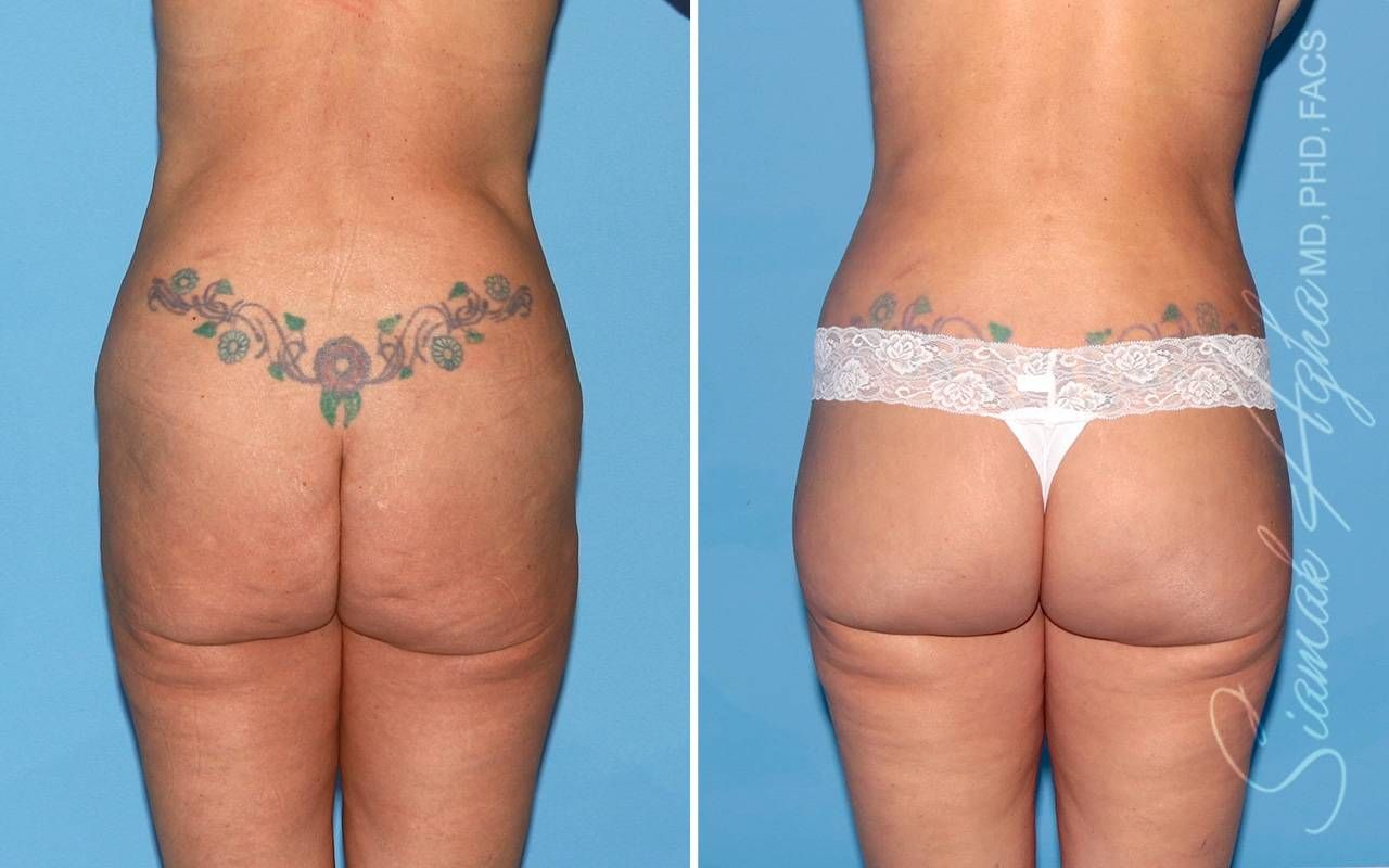Lower Body Lift Before & After