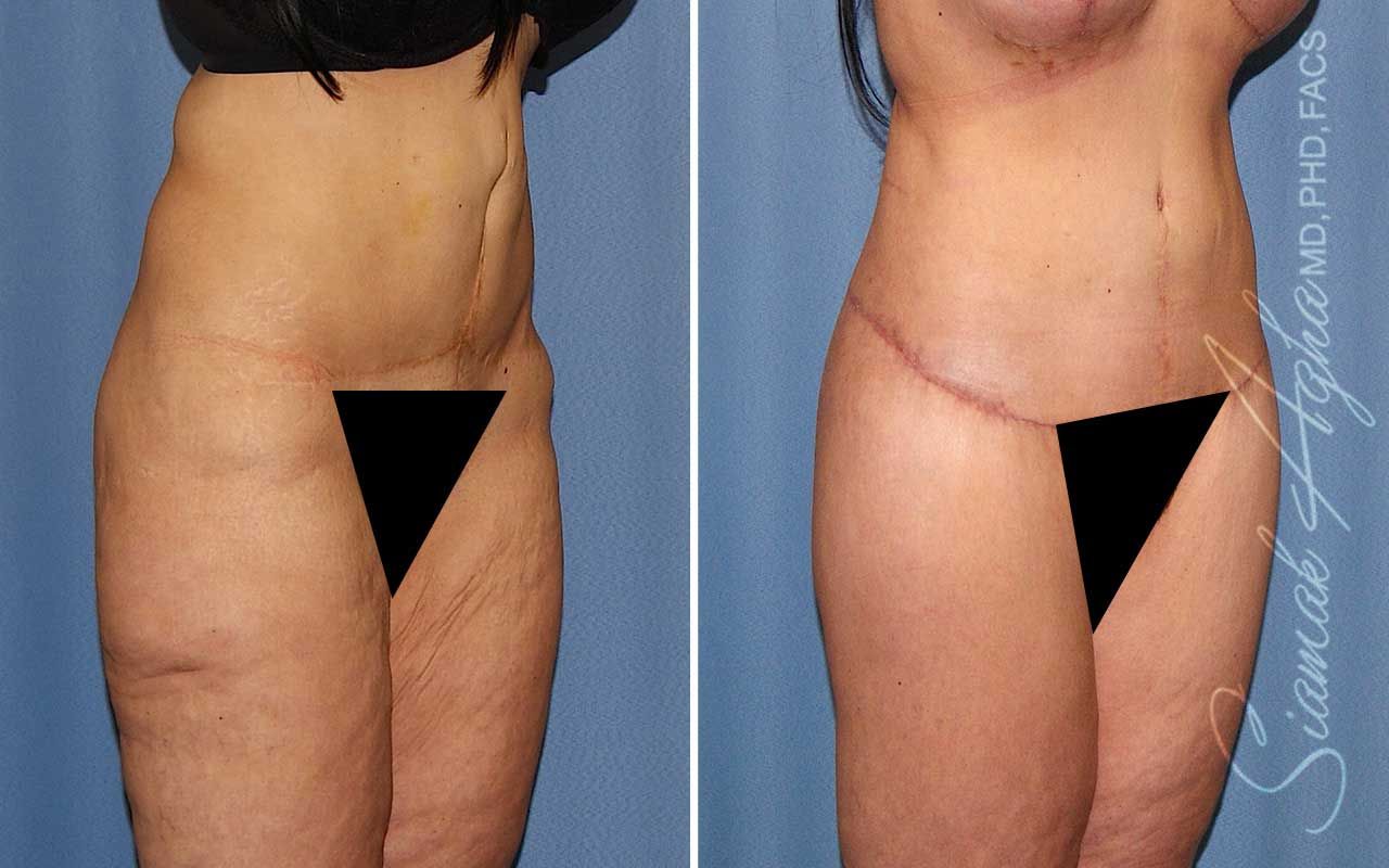 Lower Body Lift Before & After