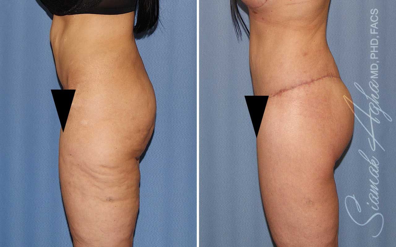 Lower Body Lift Before & After