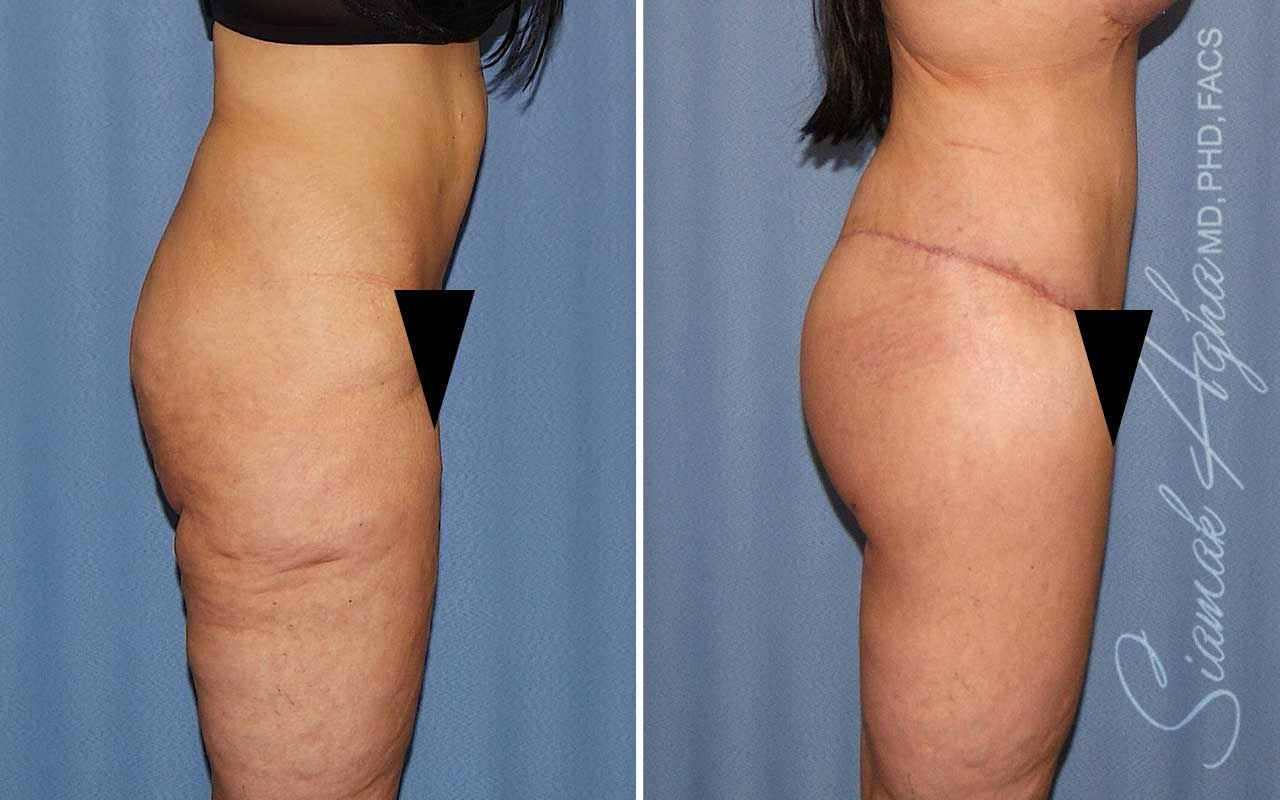 Lower Body Lift Before & After