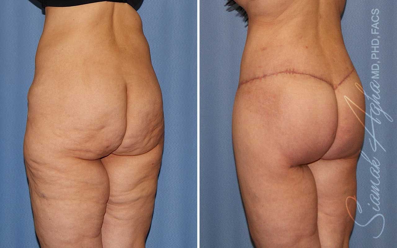 Lower Body Lift Before & After