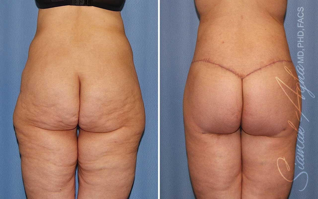 Lower Body Lift Before & After