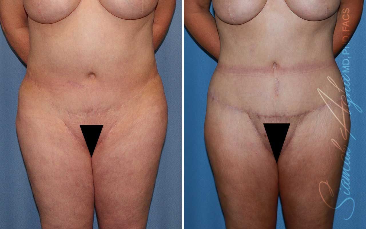 Lower Body Lift Before & After