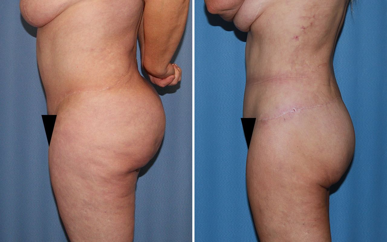 Lower Body Lift Before & After