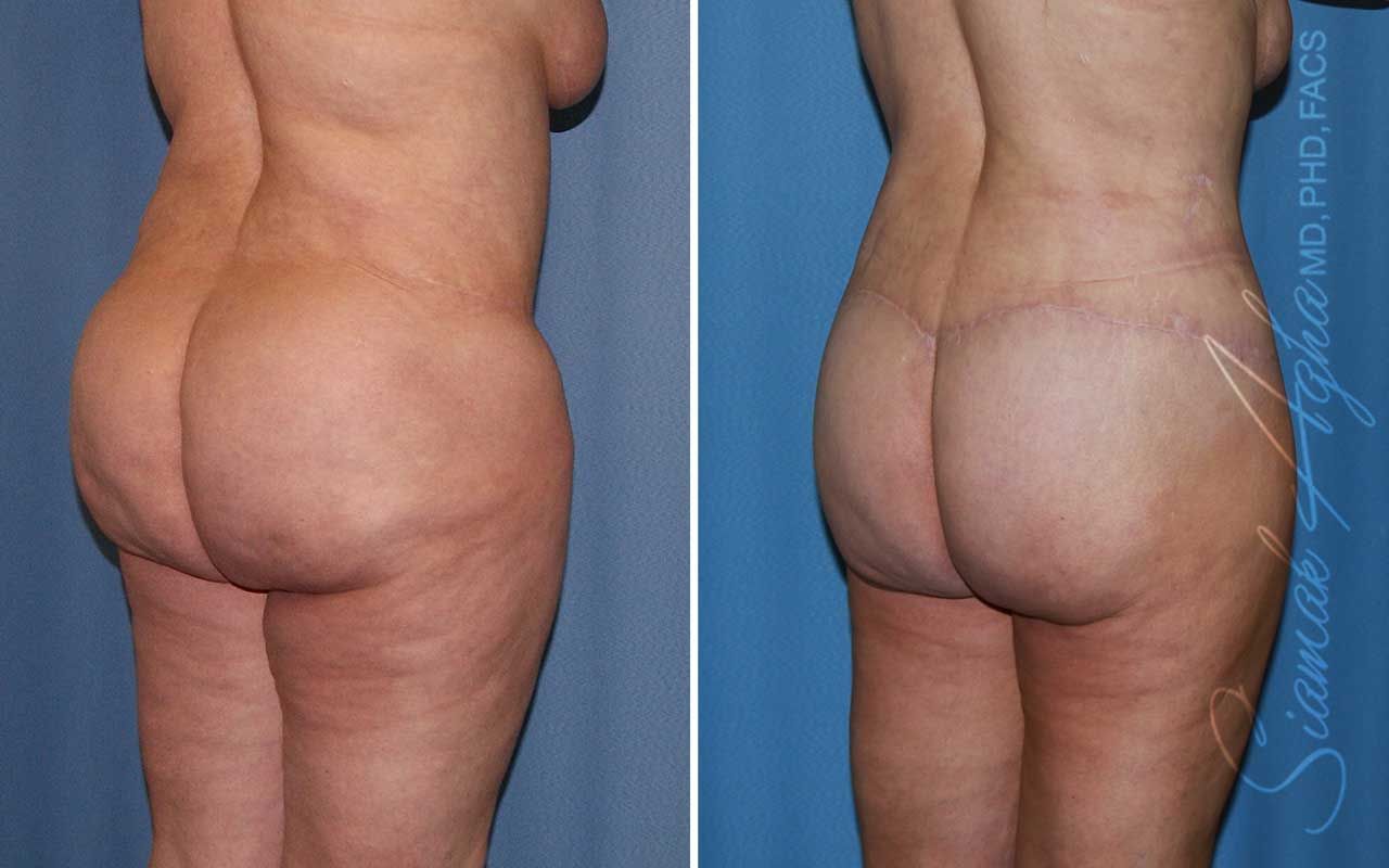 Lower Body Lift Before & After