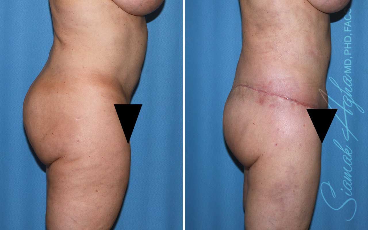 Lower Body Lift Before & After