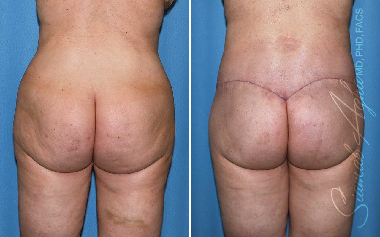 Lower Body Lift Before & After