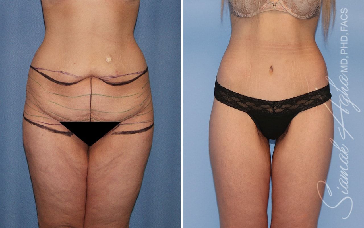 Lower Body Lift Before & After