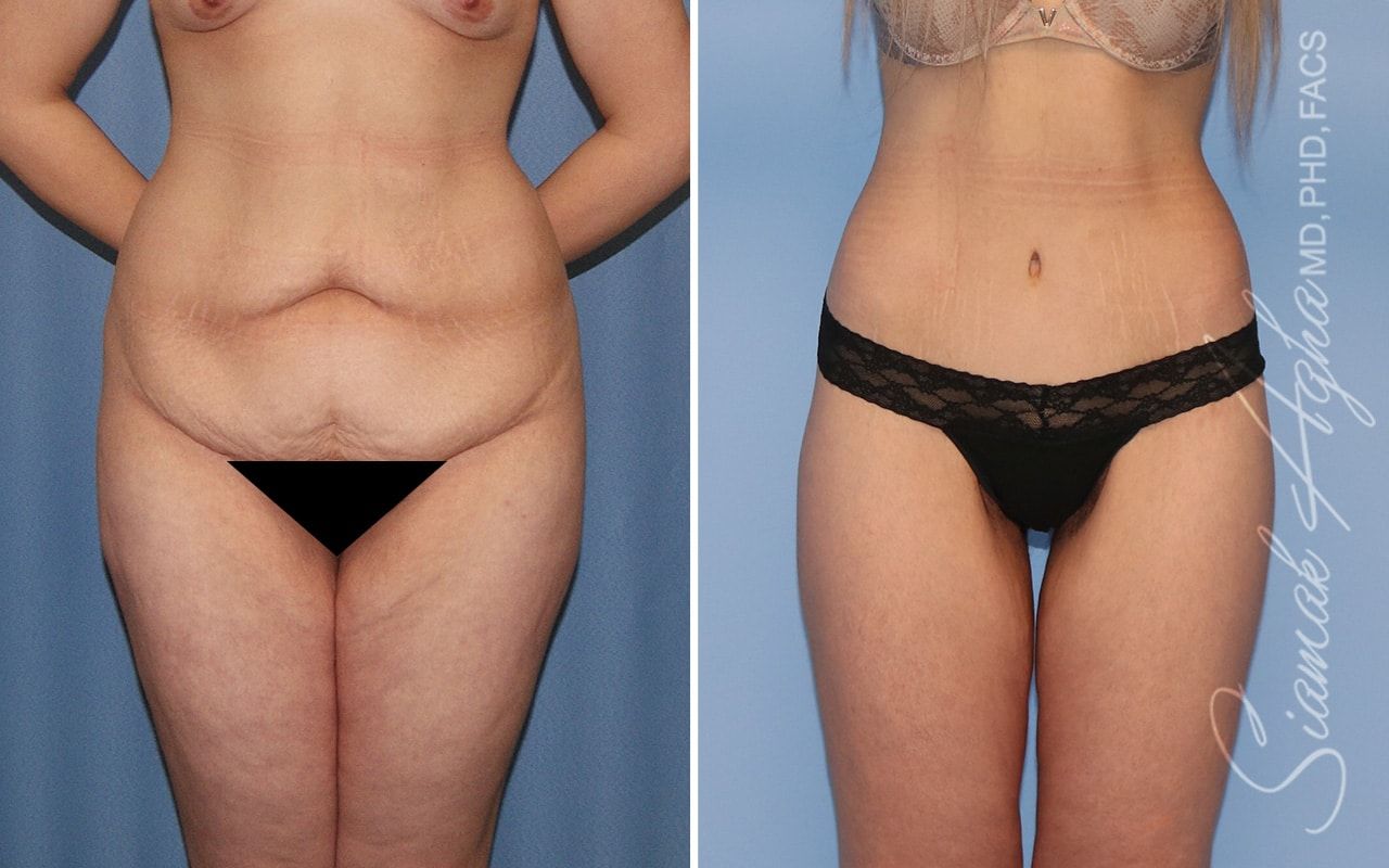 Lower Body Lift Before & After