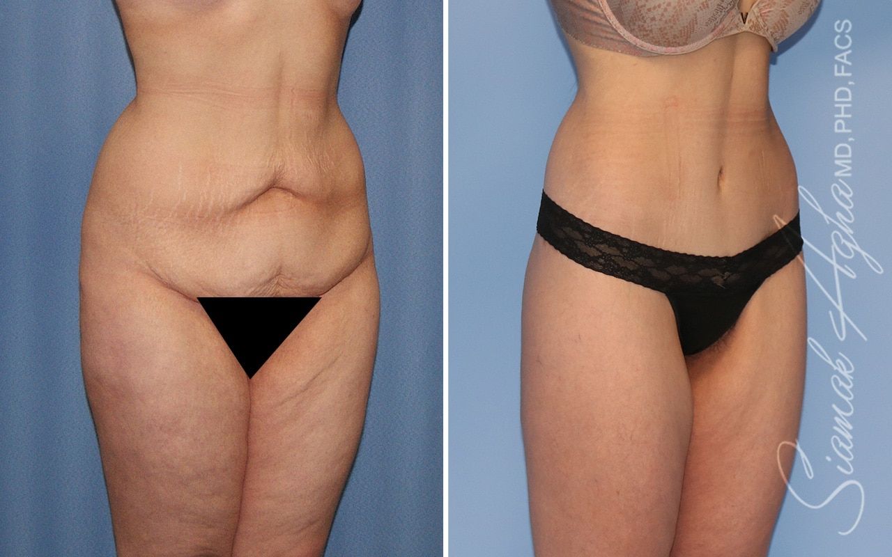 Lower Body Lift Before & After