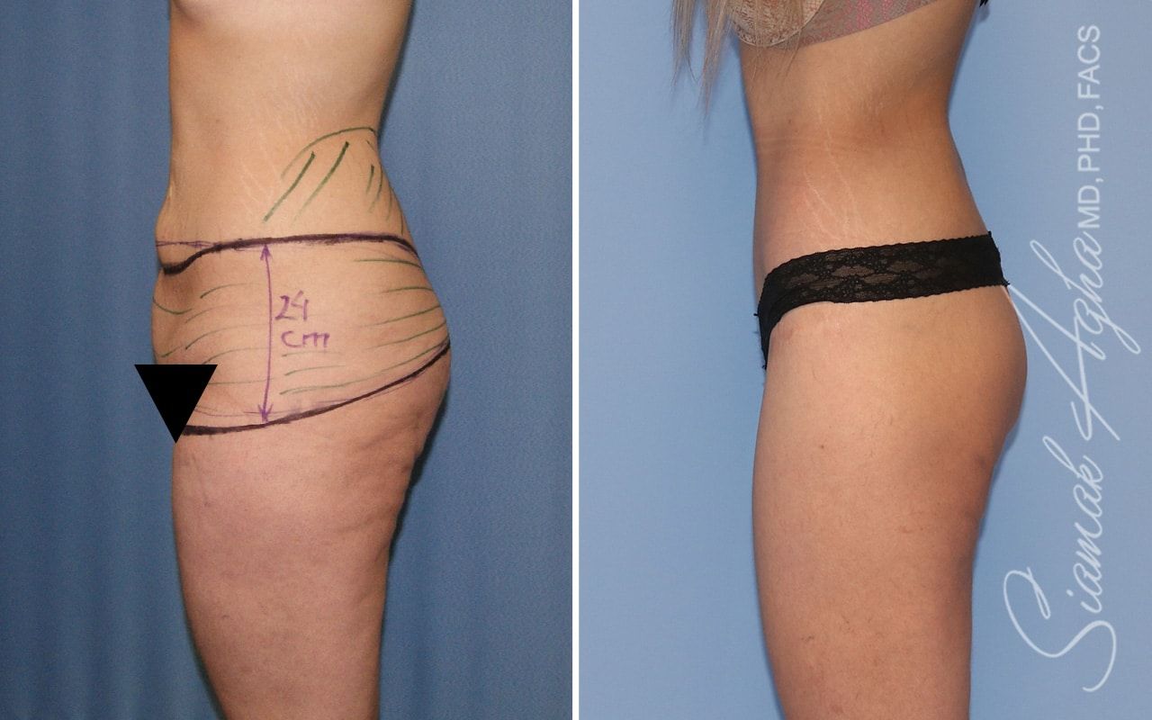 Lower Body Lift Before & After