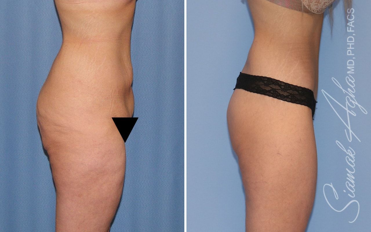 Lower Body Lift Before & After