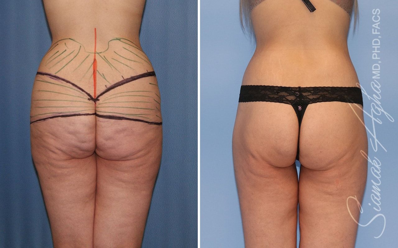 Lower Body Lift Before & After