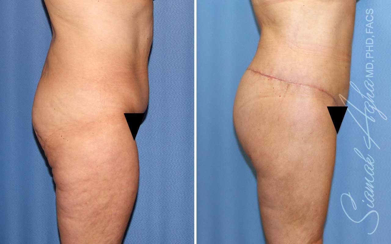 Lower Body Lift Before & After