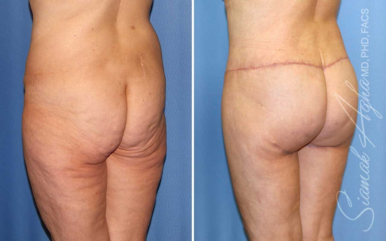 Lower Body Lift Before & After