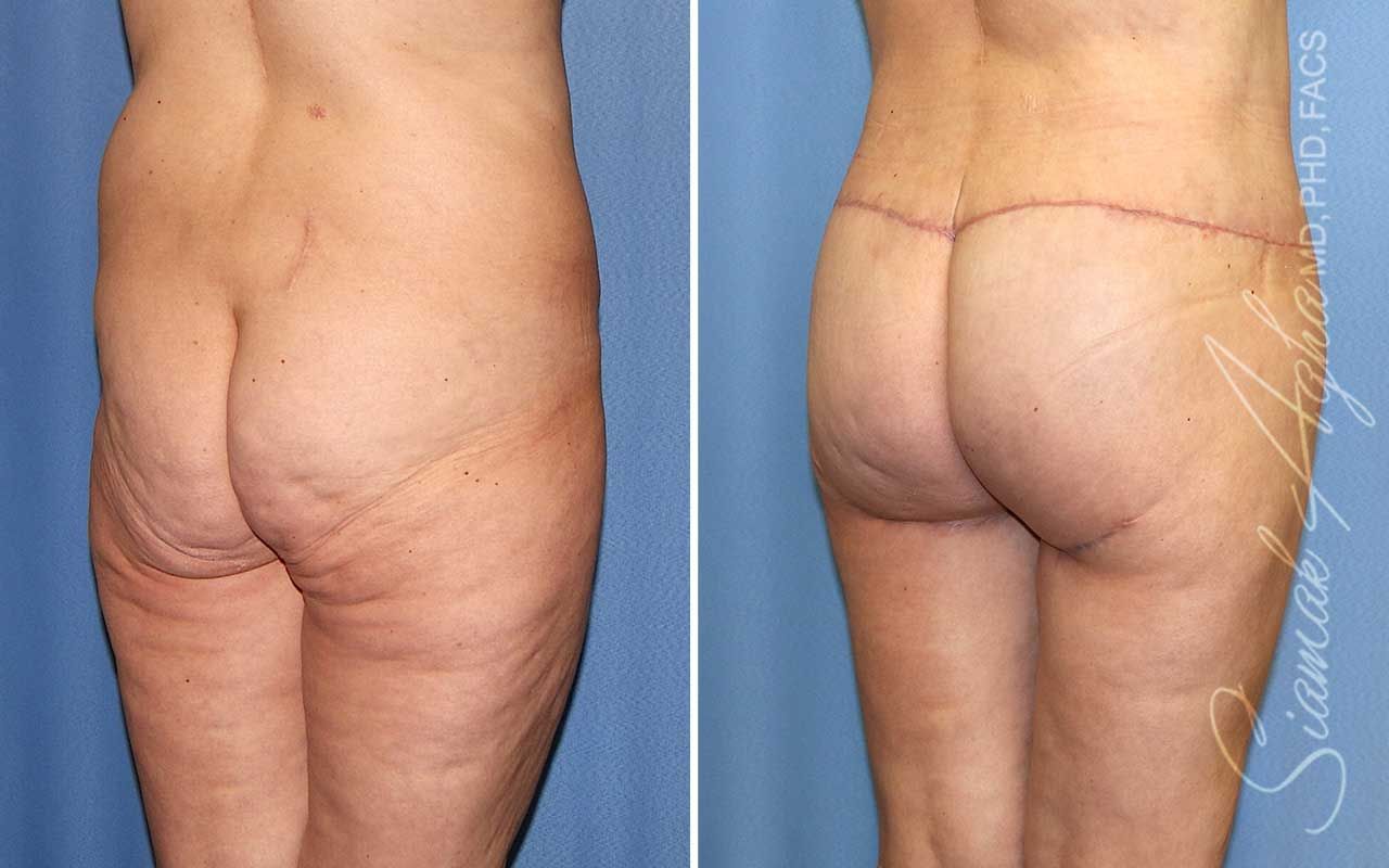 Lower Body Lift Before & After