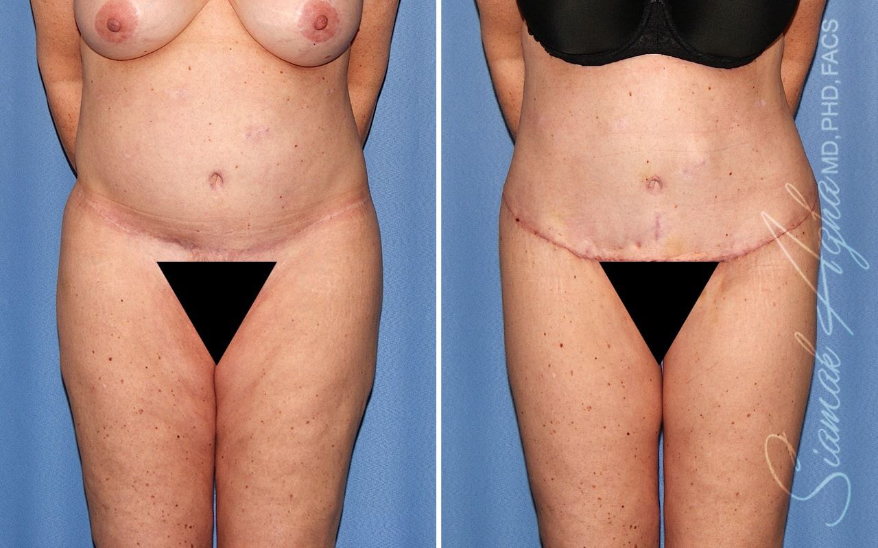 Lower Body Lift Before & After