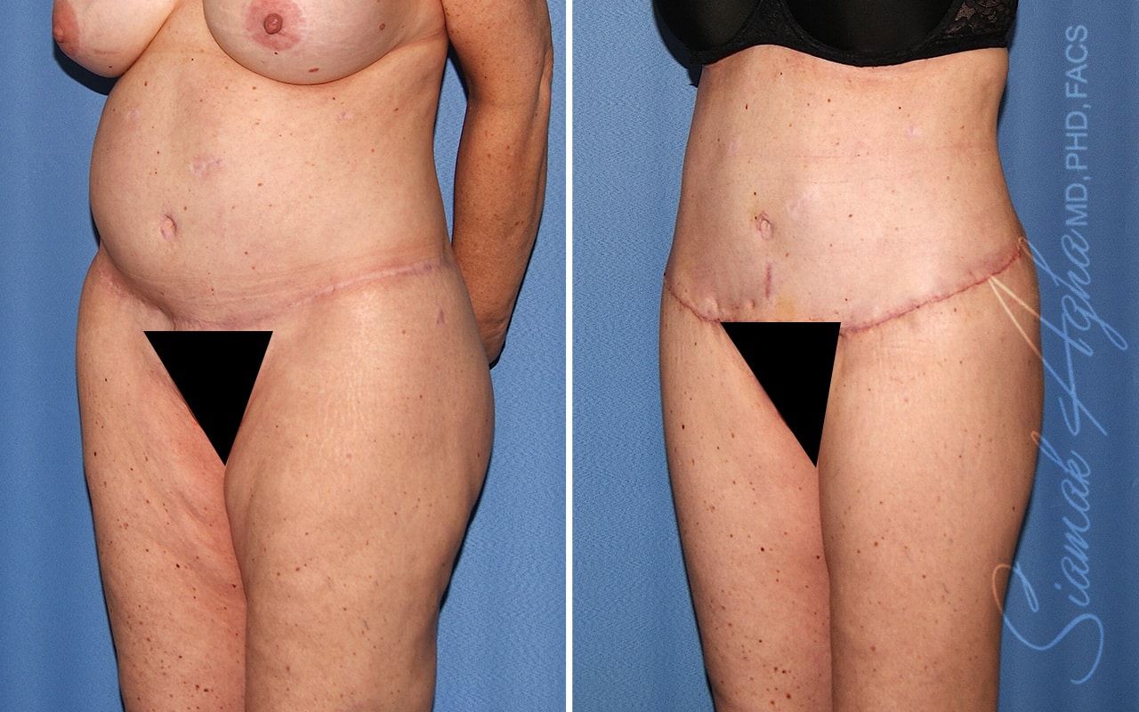 Lower Body Lift Before & After