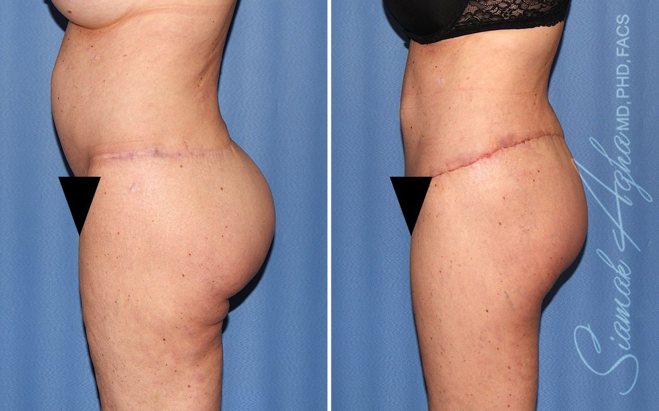 Lower Body Lift Before & After