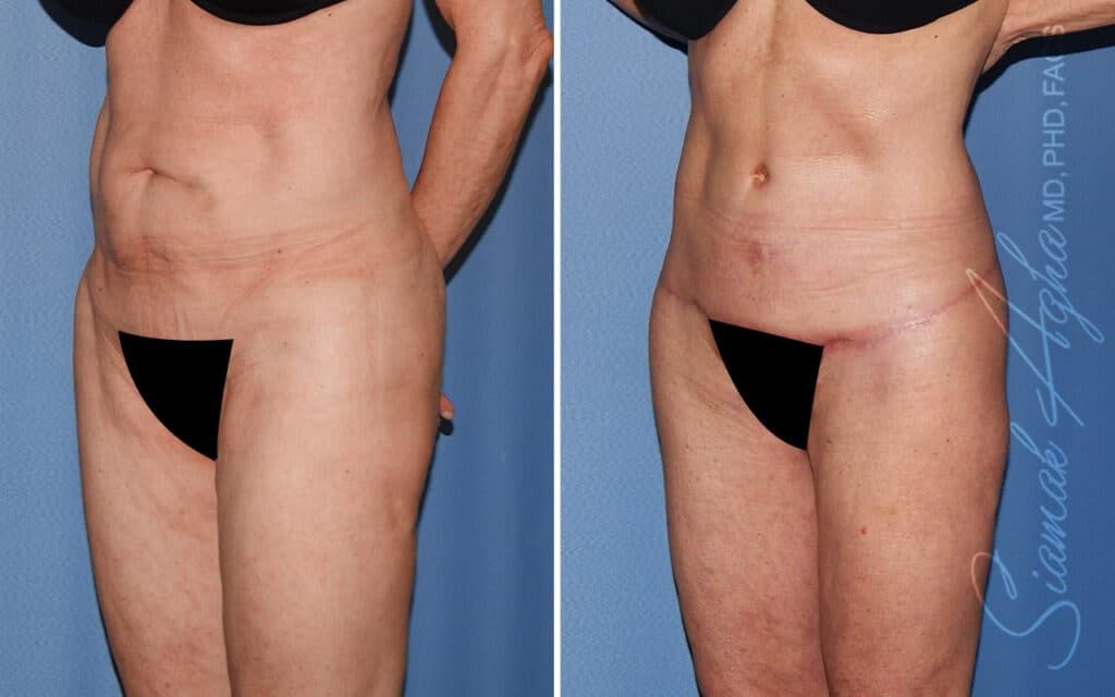 Lower Body Lift Before & After