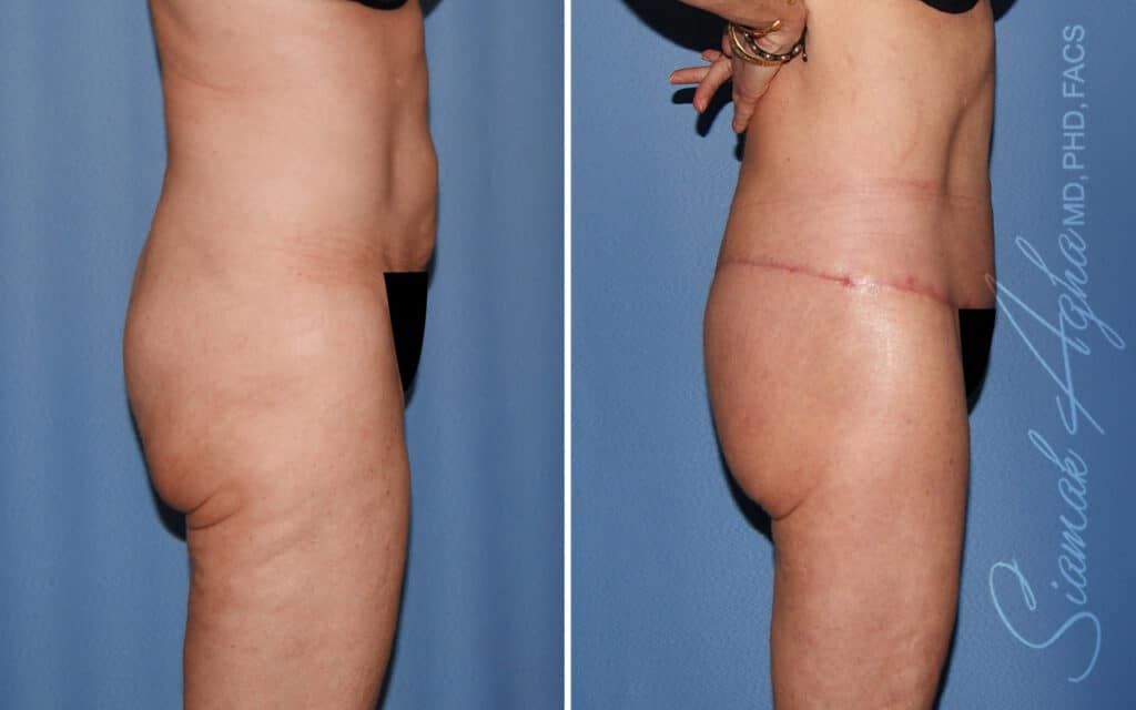 Lower Body Lift Before & After