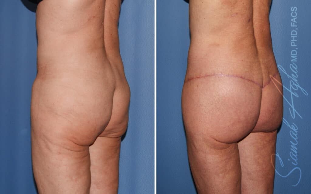 Lower Body Lift Before & After