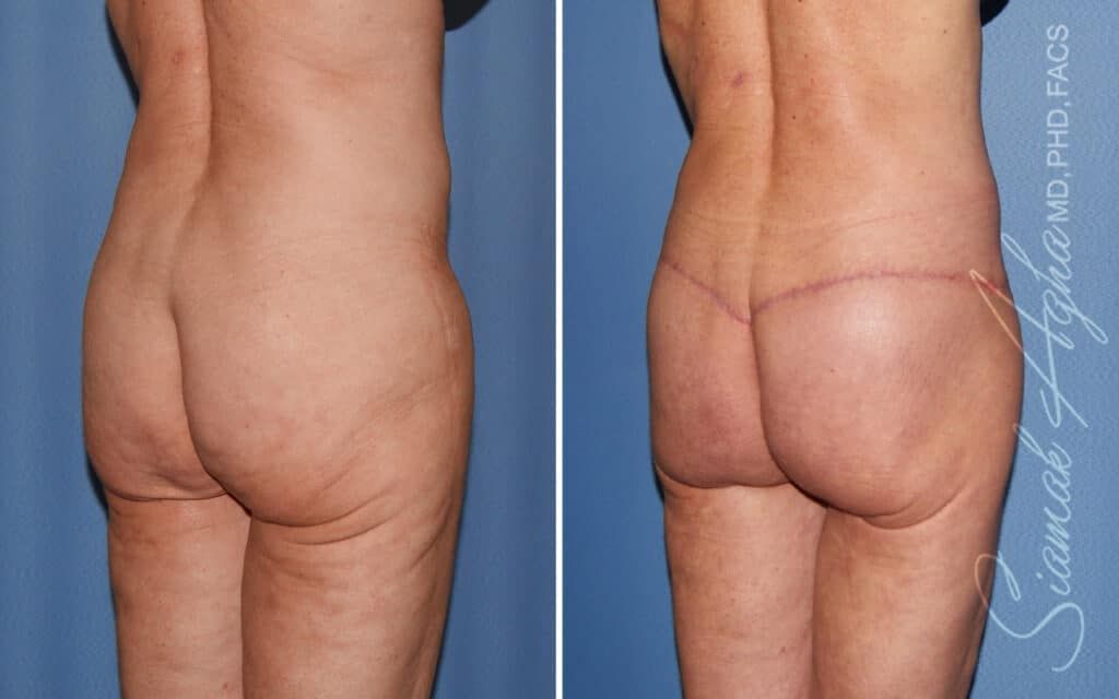 Lower Body Lift Before & After