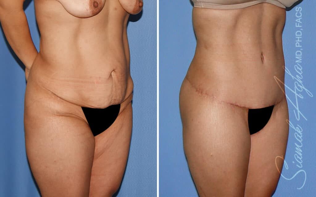 Lower Body Lift Before & After