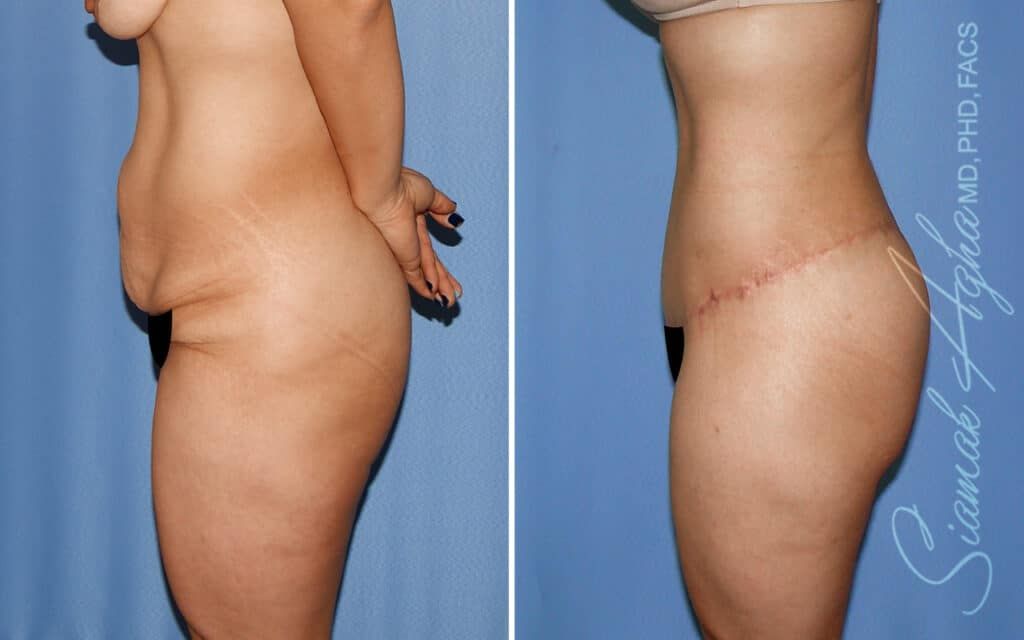 Lower Body Lift Before & After